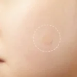 8PCS Hydrocolloid Acne & Skin Tag Healing Patches - Image 3